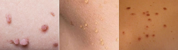 Skin Tag Removal, Sun Spot Removals Elland