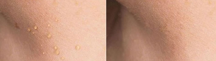 CryoPen Before and After Skin Tag Removal
