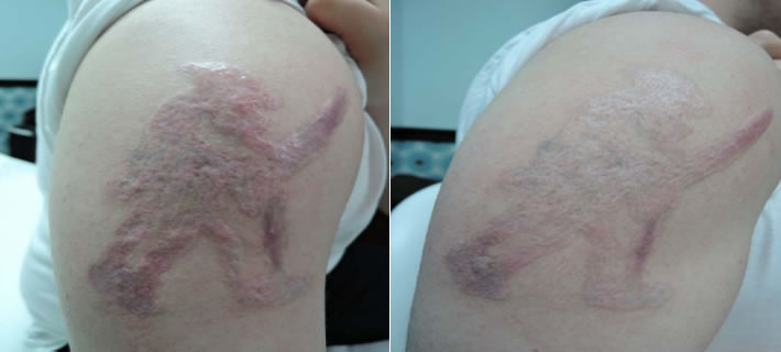Innopen -Severe burns and scars after tattoo removal Whitefield