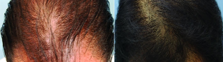 PRP - Hair Growth Glossop