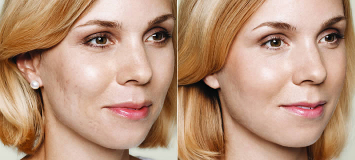 Restylane Skinboosters Halifax