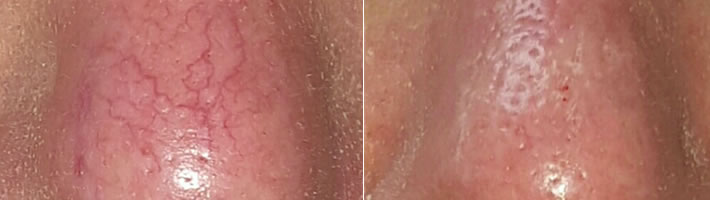 Thread Vein Removal Dewsbury
